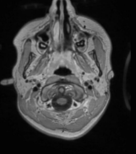 File:Choroid plexus carcinoma (Radiopaedia 91013-108553 Axial T1 C+ 65).jpg