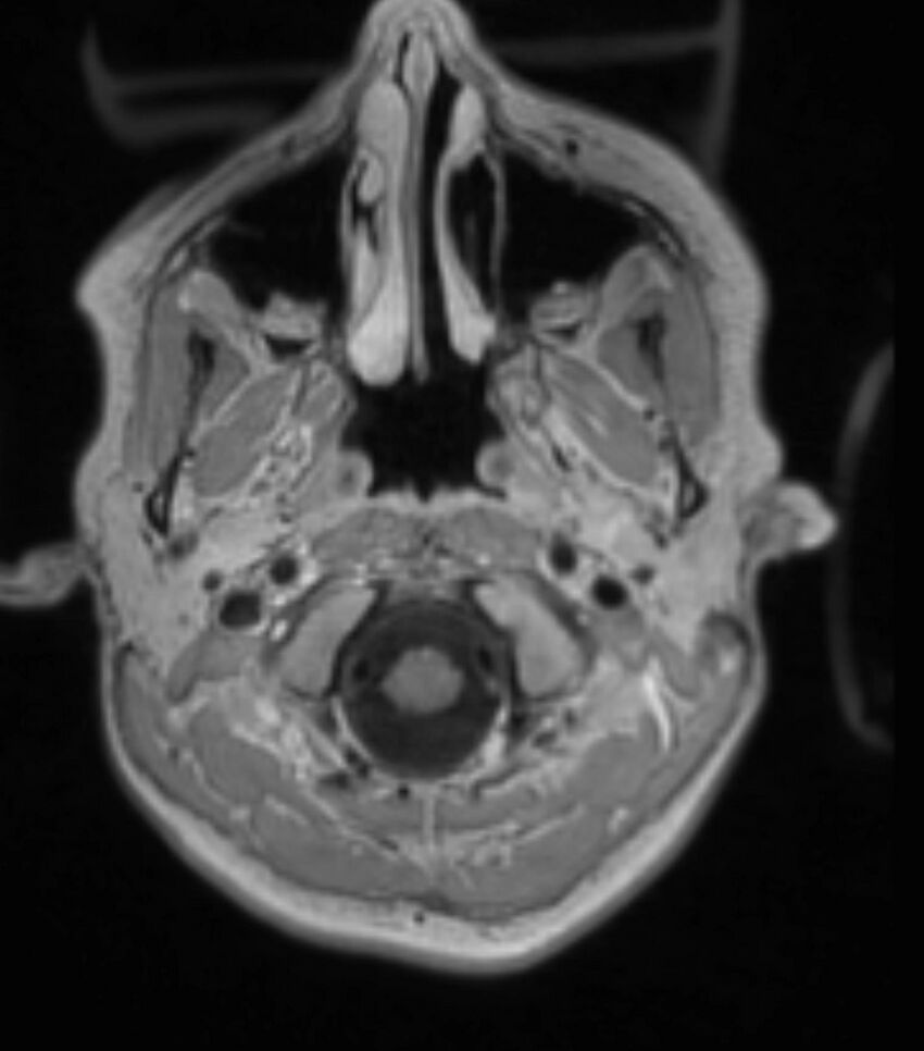Choroid plexus carcinoma (Radiopaedia 91013-108553 Axial T1 C+ 73).jpg