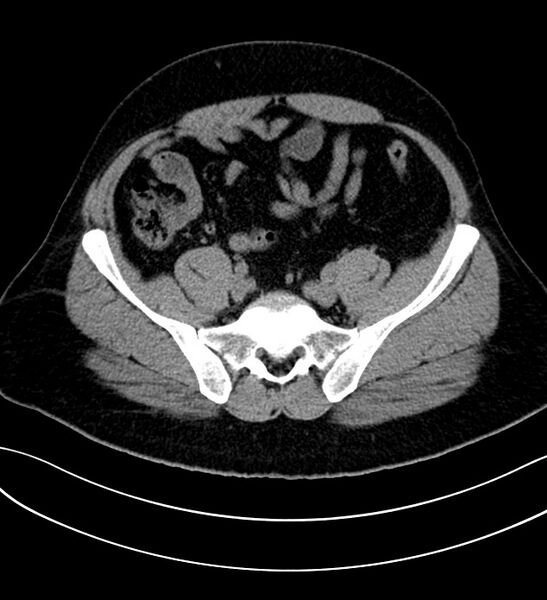 File:Chromophobe renal cell carcinoma (Radiopaedia 84286-99573 Axial non-contrast 46).jpg