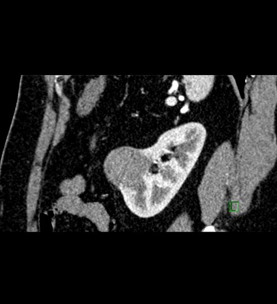 File:Chromophobe renal cell carcinoma (Radiopaedia 84286-99573 F 41).jpg