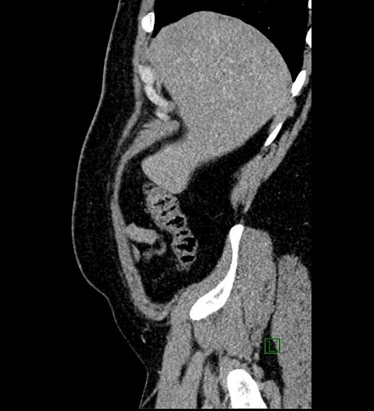 File:Chromophobe renal cell carcinoma (Radiopaedia 84286-99573 I 165).jpg