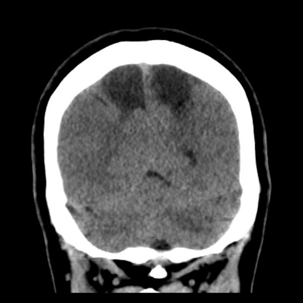 File:Chronic bilateral occipital lobe infarcts (Radiopaedia 31276-31996 Coronal non-contrast 37).jpg