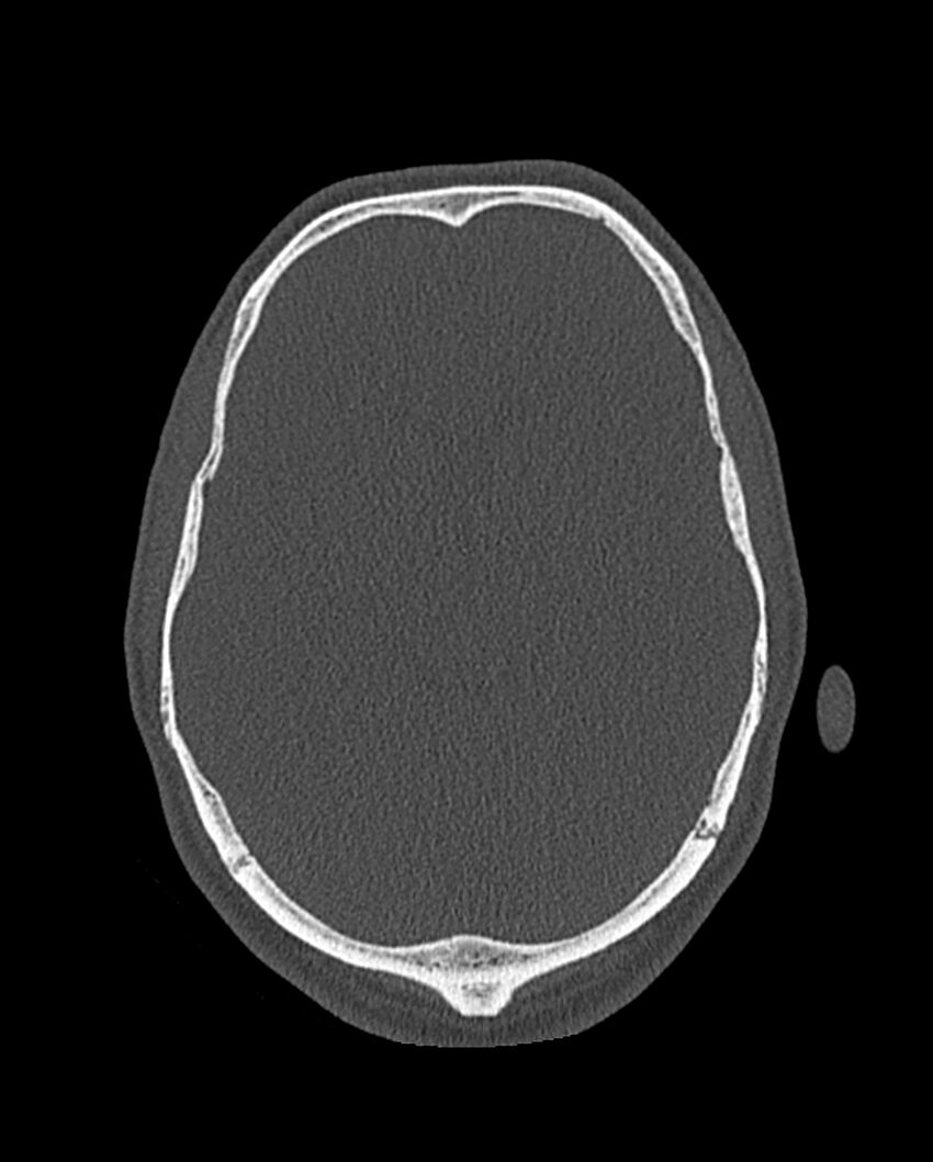 Chronic maxillary sinusitis caused by a foreign body (Radiopaedia 58521-65676 Axial bone window 344).jpg
