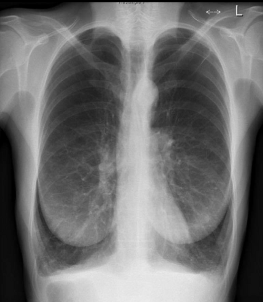 File:Chronic obstructive pulmonary disease (Radiopaedia 79884).png