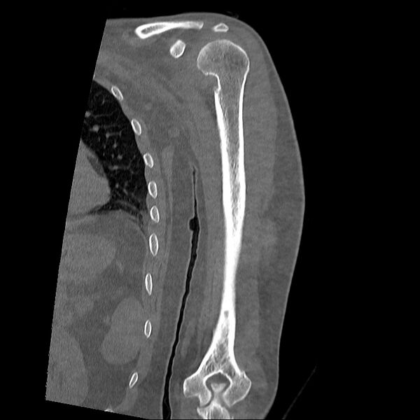 File:Chronic osteomyelitis (Radiopaedia 67597-76998 Coronal bone window 7).jpg