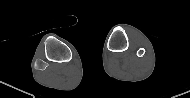 File:Chronic osteomyelitis (with sequestrum) (Radiopaedia 74813-85822 Axial non-contrast 210).jpg
