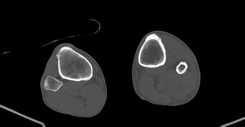 Chronic osteomyelitis (with sequestrum) (Radiopaedia 74813-85822 Axial non-contrast 210).jpg