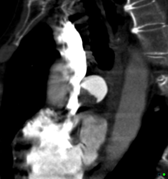 File:Chronic pulmonary embolism (Radiopaedia 17943-17702 Sagittal C+ CTPA 5).jpg