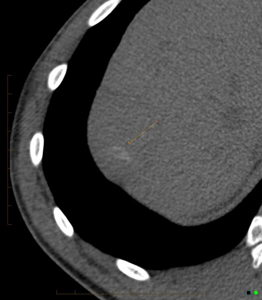 File:Chronic subcapsular hepatic hematoma (Radiopaedia 29548-30051 Axial non-contrast 1).jpg