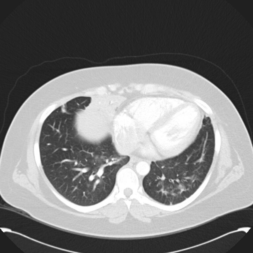 Chronic thromboembolic pulmonary hypertension (CTEPH) (Radiopaedia 74597-85531 Axial lung window 36).jpg
