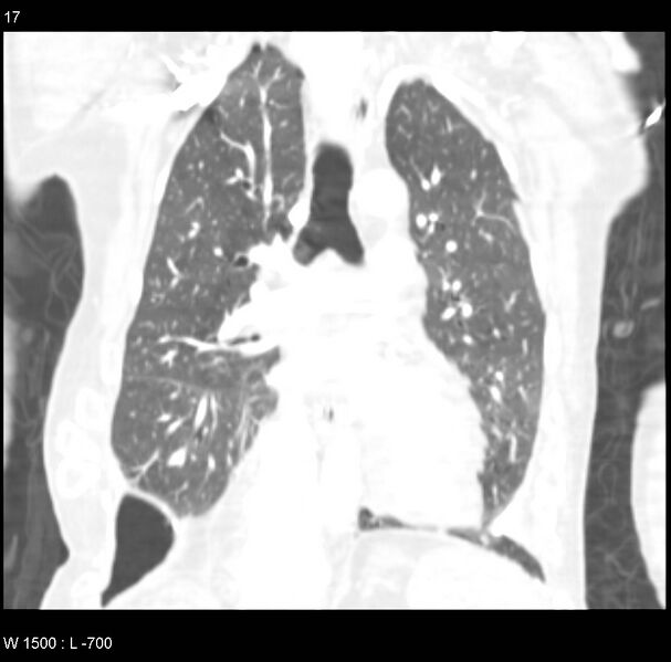 File:Clagett thoracotomy (Radiopaedia 8568-9403 Coronal lung window 17).jpg