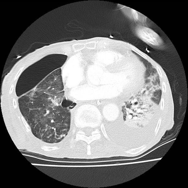 File:Clagett thoracotomy with bronchopleural fistula (Radiopaedia 29192-29587 Axial lung window 32).jpg