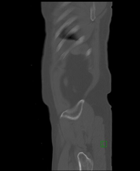 File:Clear cell renal cell carcinoma (Radiopaedia 85006-100539 Sagittal bone window 5).jpg