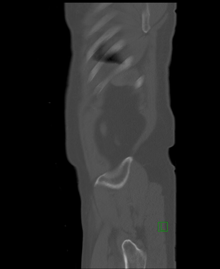 Clear cell renal cell carcinoma (Radiopaedia 85006-100539 Sagittal bone window 5).jpg
