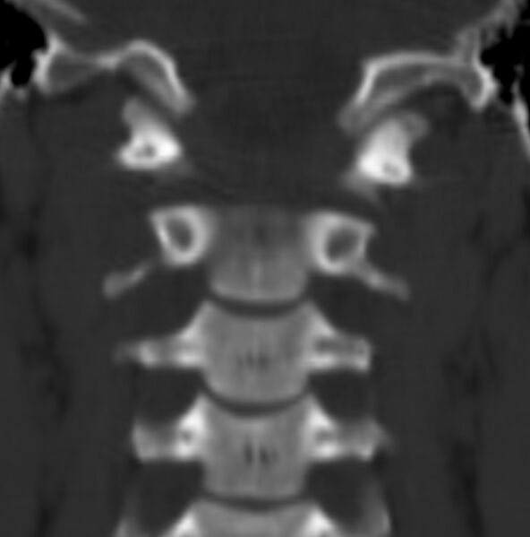 File:Cleft of the posterior arch of C1 mimicking fracture (Radiopaedia 40201-42721 Coronal bone window 11).jpg