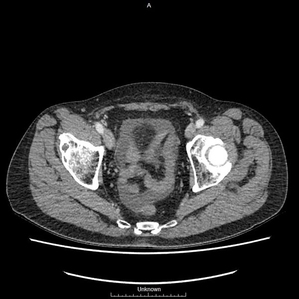 File:Closed loop bowel obstruction and ischemia (Radiopaedia 86959-103180 A 79).jpg