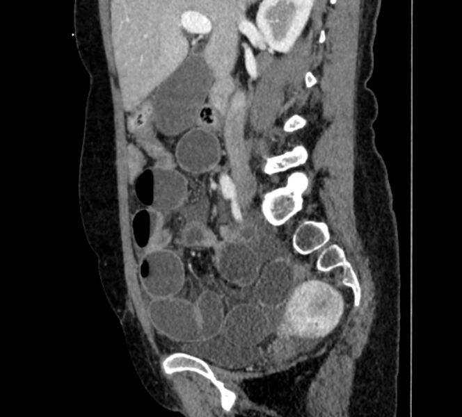 File:Closed loop small bowel obstruction (Radiopaedia 71211-81508 C 53).jpg