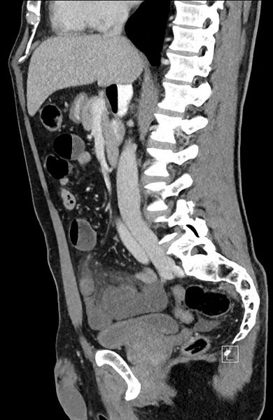 File:Closed loop small bowel obstruction - internal hernia (Radiopaedia 57806-64778 C 62).jpg