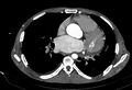 Coarctation of aorta with aortic valve stenosis (Radiopaedia 70463-80574 A 113).jpg