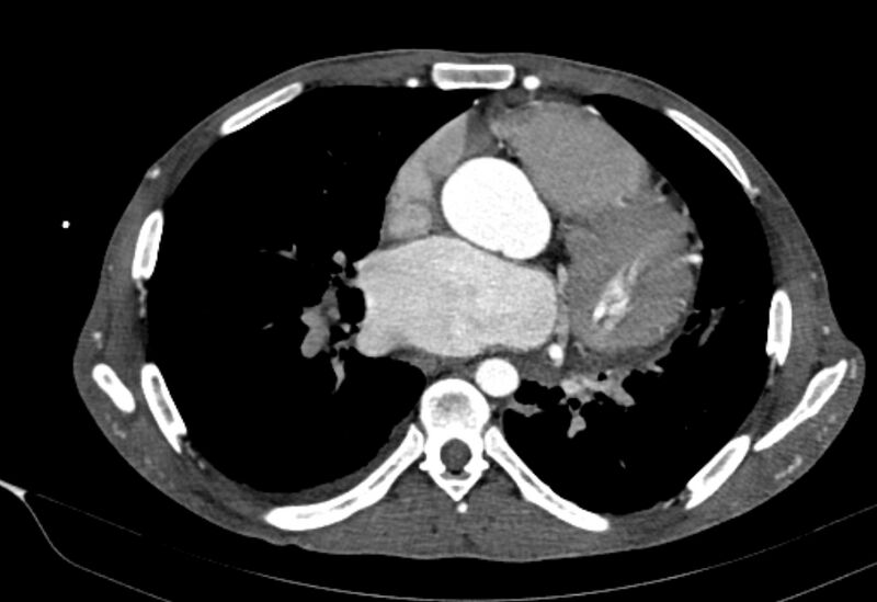 File:Coarctation of aorta with aortic valve stenosis (Radiopaedia 70463-80574 A 113).jpg