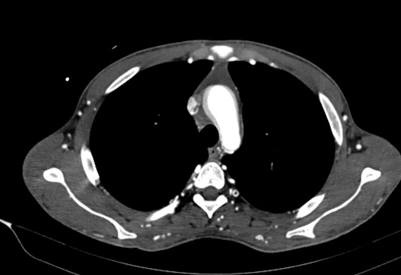 File:Coarctation of aorta with aortic valve stenosis (Radiopaedia 70463-80574 A 38).jpg