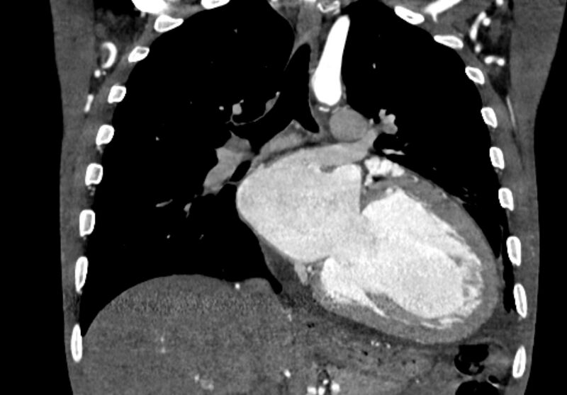 File:Coarctation of aorta with aortic valve stenosis (Radiopaedia 70463-80574 C 126).jpg