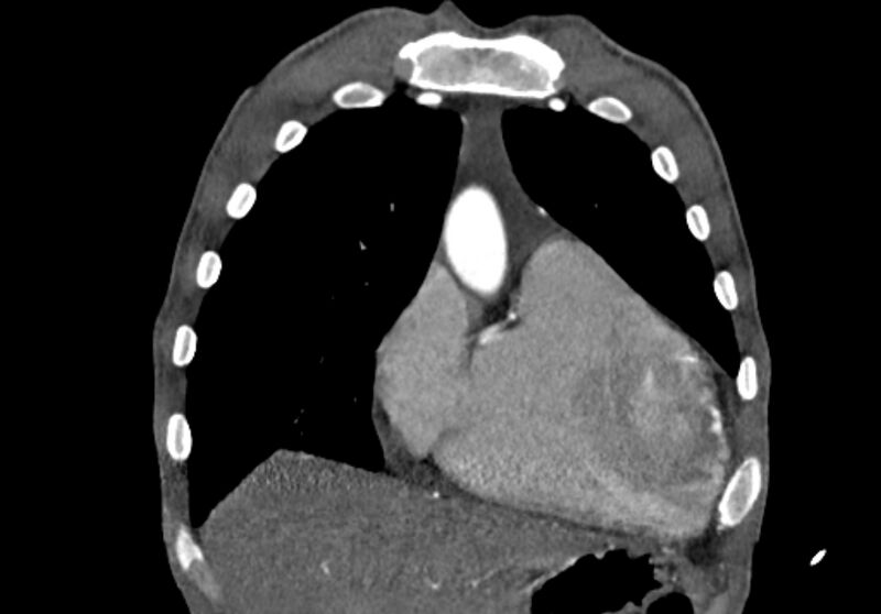 File:Coarctation of aorta with aortic valve stenosis (Radiopaedia 70463-80574 C 38).jpg