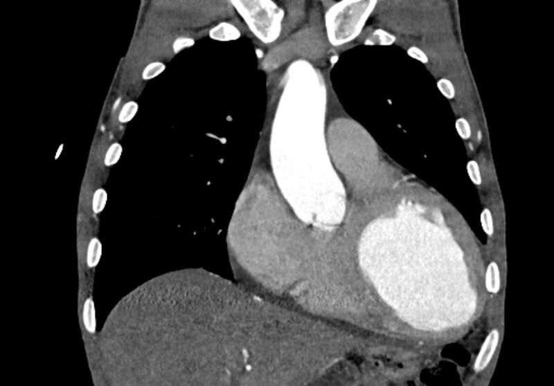 File:Coarctation of aorta with aortic valve stenosis (Radiopaedia 70463-80574 C 68).jpg