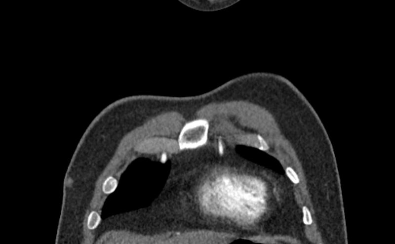 File:Coarctation of the aorta (Radiopaedia 53363-59343 C 5).jpg