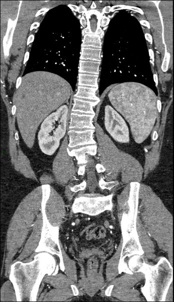 File:Coarctation of the aorta (Radiopaedia 74632-88521 B 173).jpg
