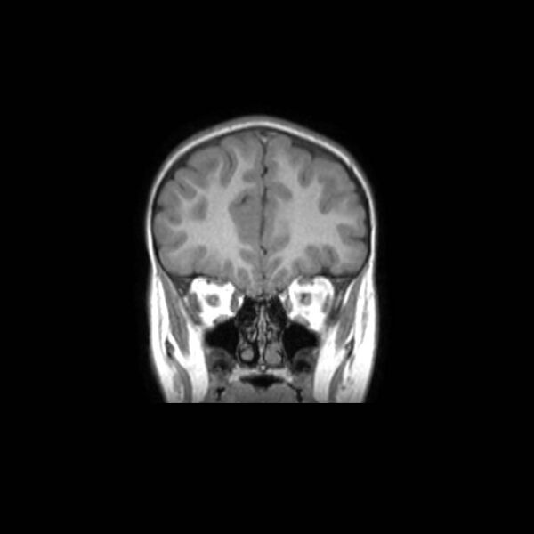 File:Cochlear nerve aplasia - unilateral (Radiopaedia 87910-104413 Coronal T1 13).jpg