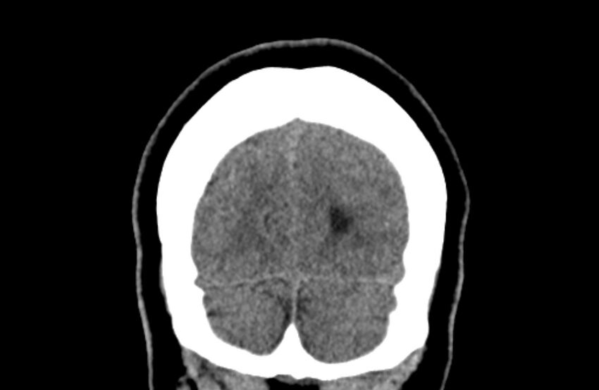 Colloid cyst (Radiopaedia 53180-59146 Coronal non-contrast 77).jpg