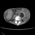 Colocolic fistula - Crohn disease (Radiopaedia 57063-63955 A 37).jpg
