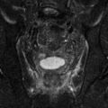 Colonic fistula (Radiopaedia 16047-15708 Coronal T2 fat sat 26).jpg