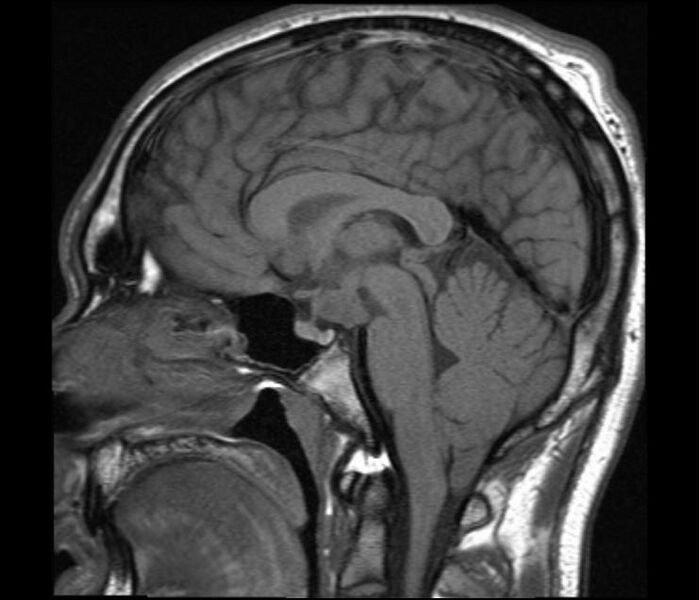 File:Hypothalamic hamartoma (Radiopaedia 16890).jpeg