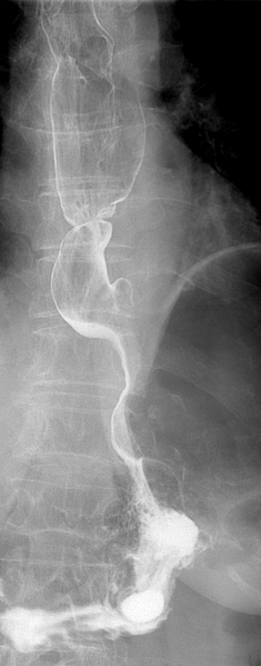 File:Lower esophageal stricture (Radiopaedia 31278).png
