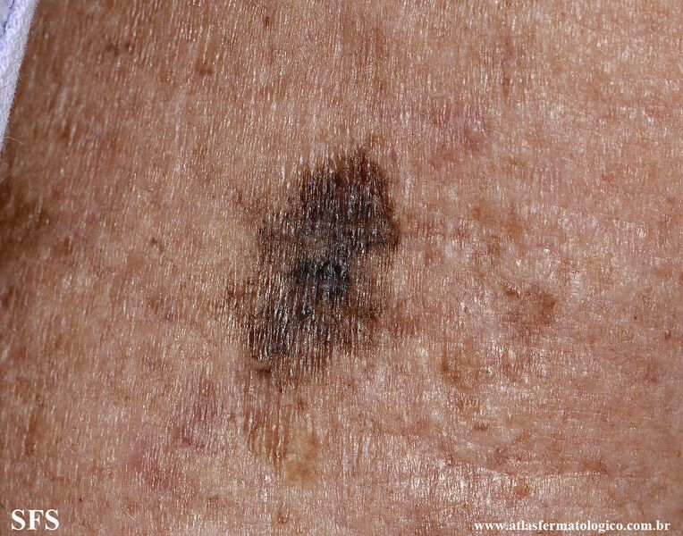File:Melanoma (Dermatology Atlas 121).jpg