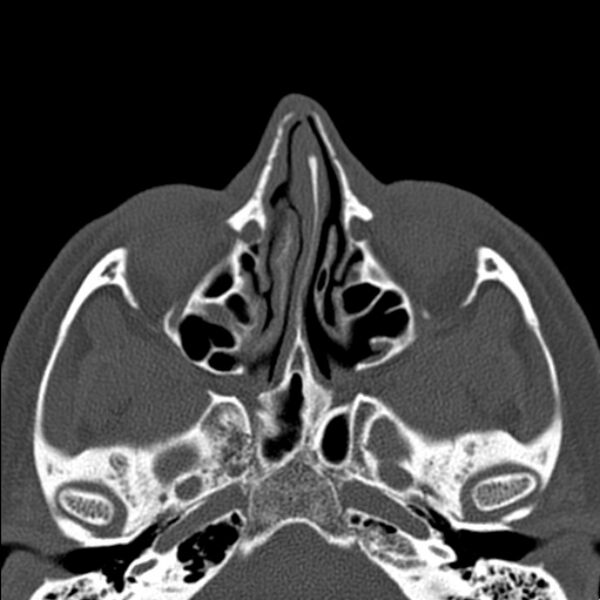 File:Nasal septal perforation (Radiopaedia 25030-25289 Axial bone window 27).jpg