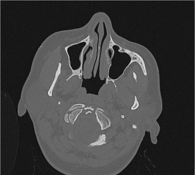 File:Nasolabial cyst (Radiopaedia 25322-25580 Axial bone window 9).jpg
