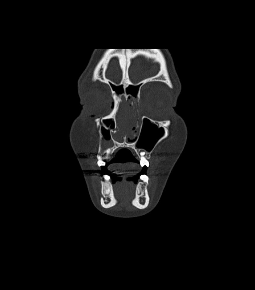Nasoorbitoethmoid fracture (Radiopaedia 90044-107205 Coronal bone window 34).jpg