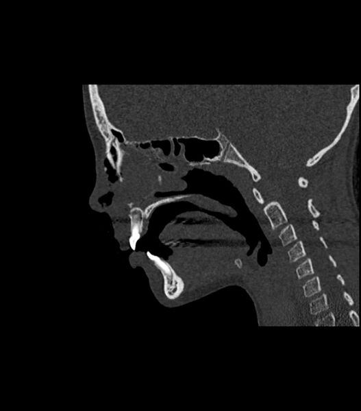 File:Nasoorbitoethmoid fracture (Radiopaedia 90044-107205 Sagittal bone window 79).jpg