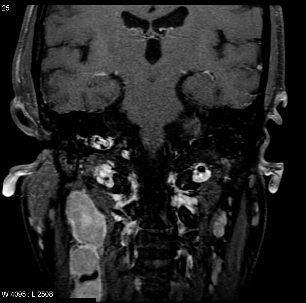 File:Nasopharyngeal carcinoma (Radiopaedia 4546-6667 E 15).jpg