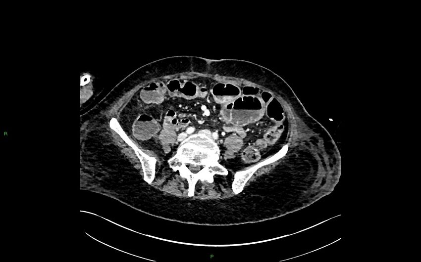 Neo-terminal ileal stricture (Crohn disease) (Radiopaedia 33790-34948 A 300).jpg