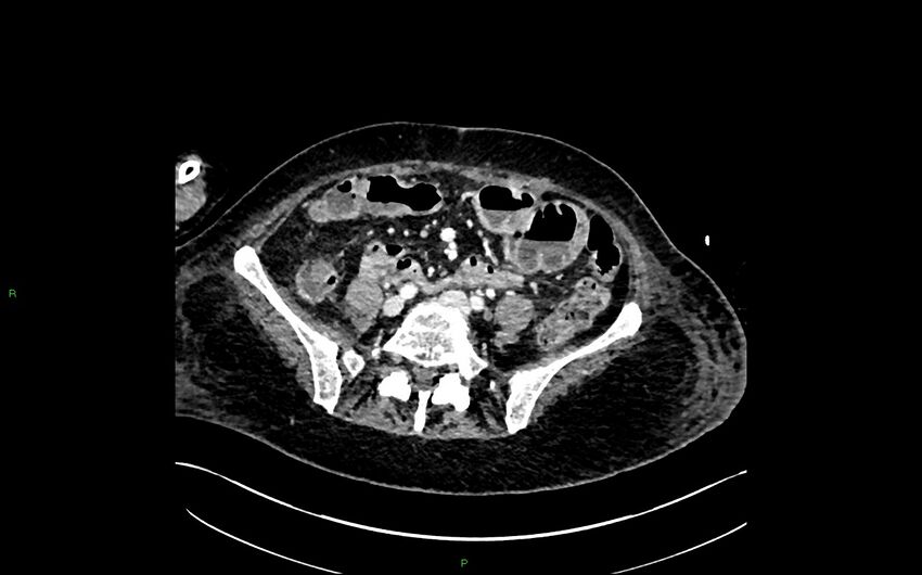Neo-terminal ileal stricture (Crohn disease) (Radiopaedia 33790-34948 A 311).jpg