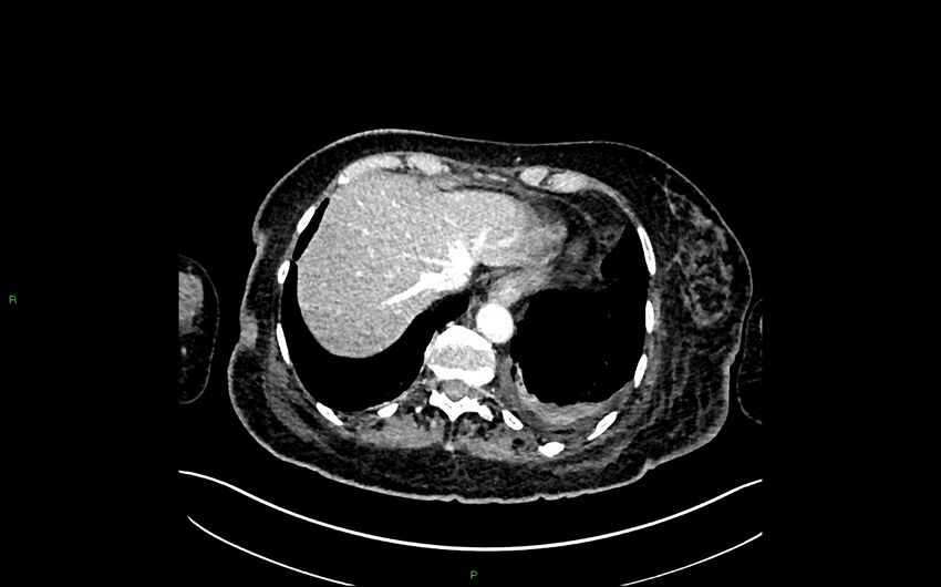 Neo-terminal ileal stricture (Crohn disease) (Radiopaedia 33790-34948 A 47).jpg