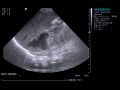 Neonatal adrenal hemorrhage (Radiopaedia 40215-42751 Longitudinal 1).JPG