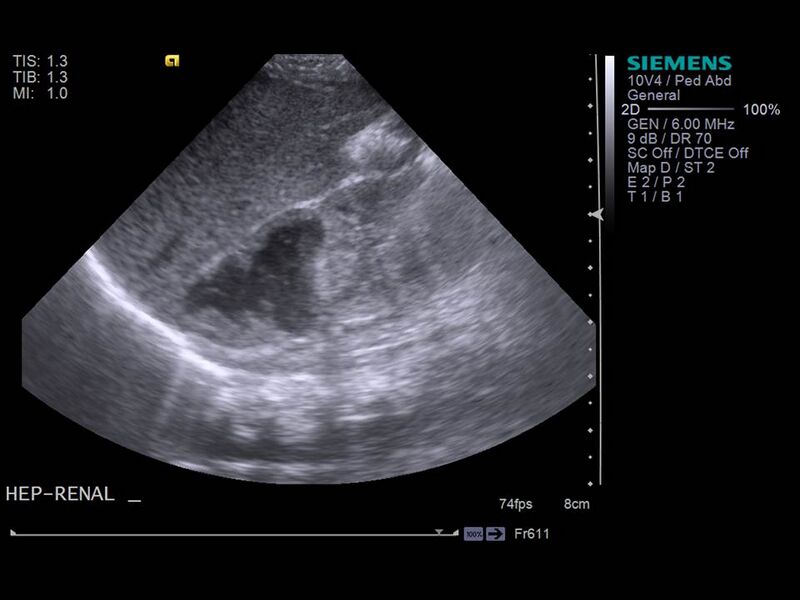File:Neonatal adrenal hemorrhage (Radiopaedia 40215-42751 Longitudinal 1).JPG
