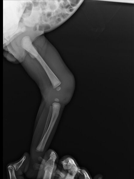 File:Neonatal knee septic arthritis (Radiopaedia 13358-13359 Lateral 1).jpg