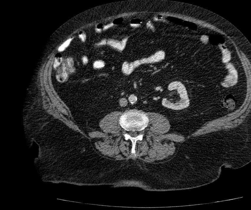 Nephroptosis with inguinal hernia containing perirenal fat (Radiopaedia 56632-63391 C 194).jpg