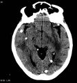 Neurocysticercosis (Radiopaedia 7773-8596 non-contrast 4).jpg